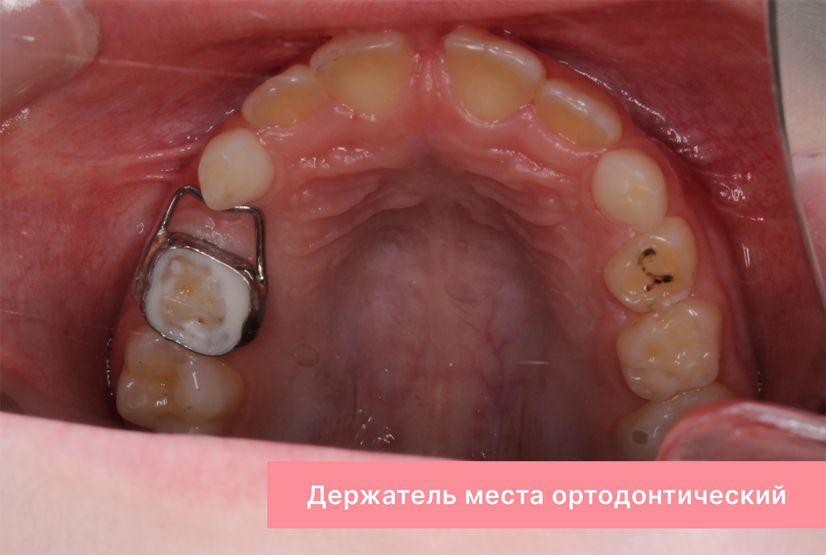 Ортодонтический держатель места