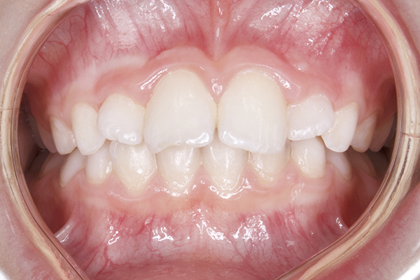 Зубы ребенка до лечения на аппарате Марко-Роса