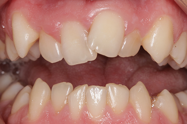 Зубы до лечения на комбинированной брекет-системе Clarity 3M + Victory