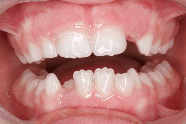 зубы ребенка до лечения на аппарате Марко Роса