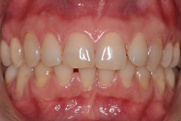 Зубы до лечения на металлической брекет-системе Damon Q