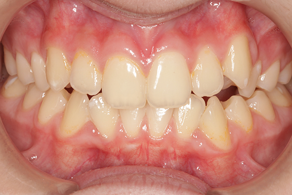 Зубы до лечения на самолигирующей металлической брекет-системе Pitts21