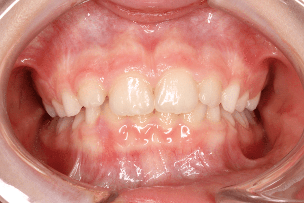 Зубы ребенка после лечения на аппарате Марко Роса
