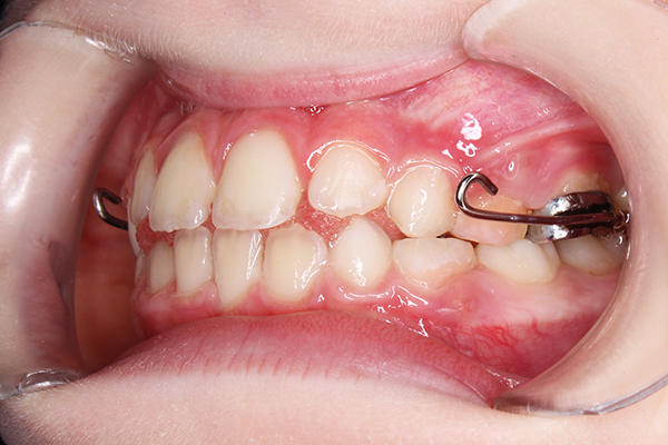 Зубы ребенка после лечения на аппарате Марко-Роса