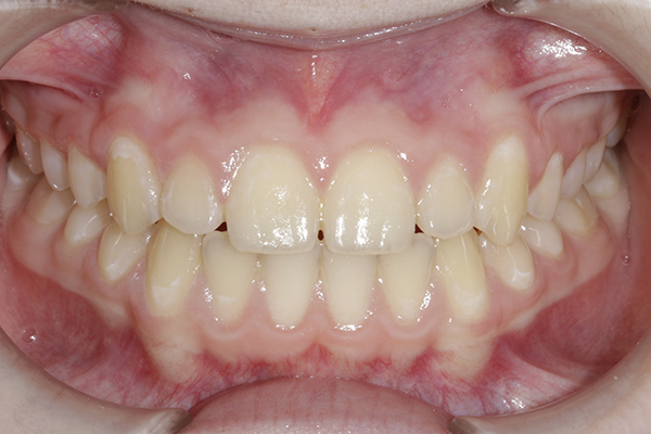 Зубы после лечения на комбинированной брекет-системе Clarity 3M + Victory