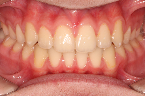 Зубы после лечения на металлической-лигатурной брекет-системе Mini Diamond