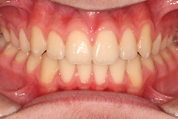 Зубы после лечения на самолигирующей металлической брекет-системе Pitts21