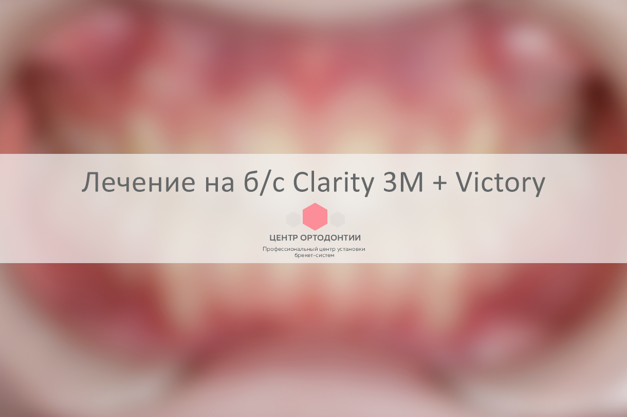 Пример лечения на брекет-системе Clarity 3M + Victory