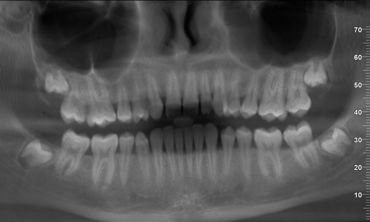 Ортопантомограмма (панорамный снимок) зубов